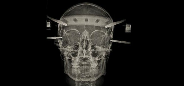 Radiograph of a patient in a "halo" fixation device designed to stabilize the skull while a spine fracture heals. It's also a good representation of what it feels like to have everything you need to learn during a radiology residency drilled into your skull.